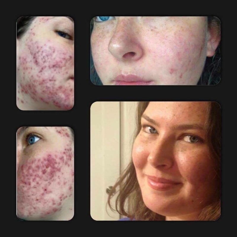 Get rid of your acne, psoriasis and eczema!!!